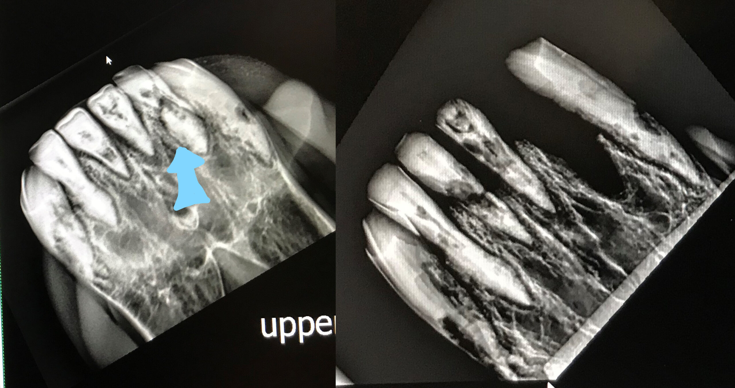 Radiographs showing abnormal tooth roots (pale blue arrow points to fractured tooth) surrounded by irregular bone.  Radiograph on the right shows after one extraction, but other teeth will need extracting too.