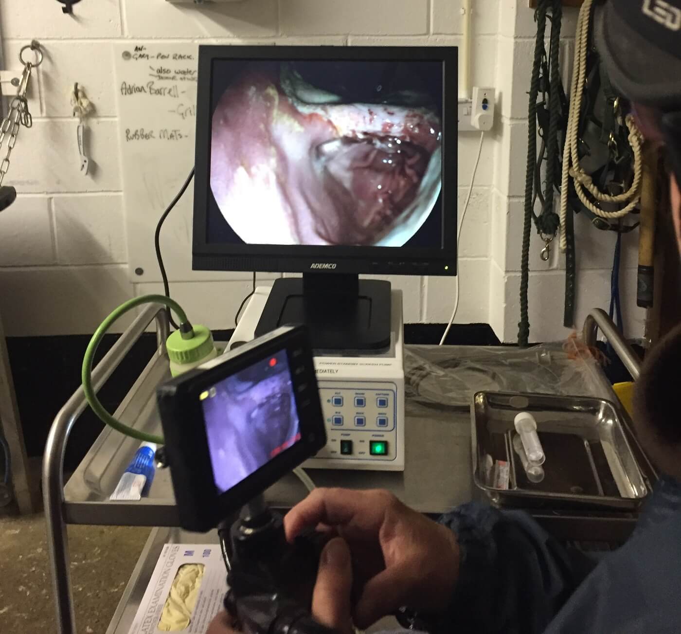 Grade 4 Squamous ulcers on the screen using Deben Valley's Gastroscope