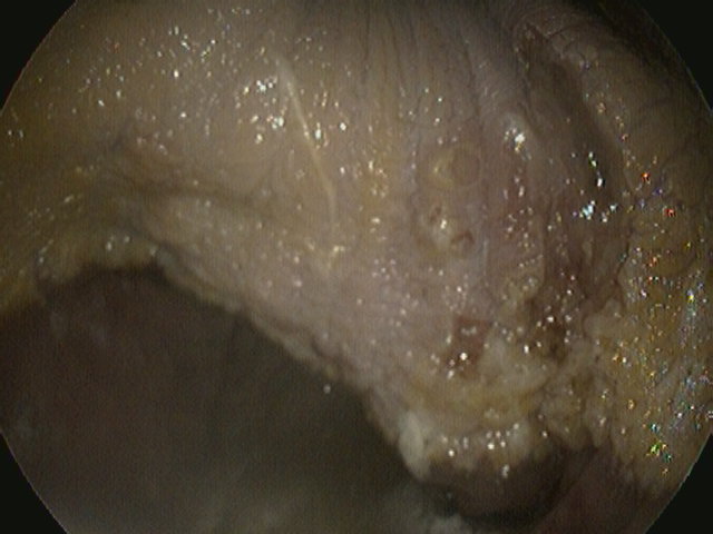 Squamous ulceration grade 4 - bleeding