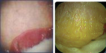 Normal squamous surface                                                                          Grade 1 ulceration (yellow and thickened stomach lining