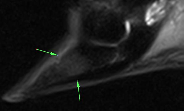 MRI scan of Tottie's foot. The white area between the green arrows is abnormal and represents bone oedema (bruising)